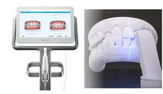 3D光学口腔内スキャナー（iTero）