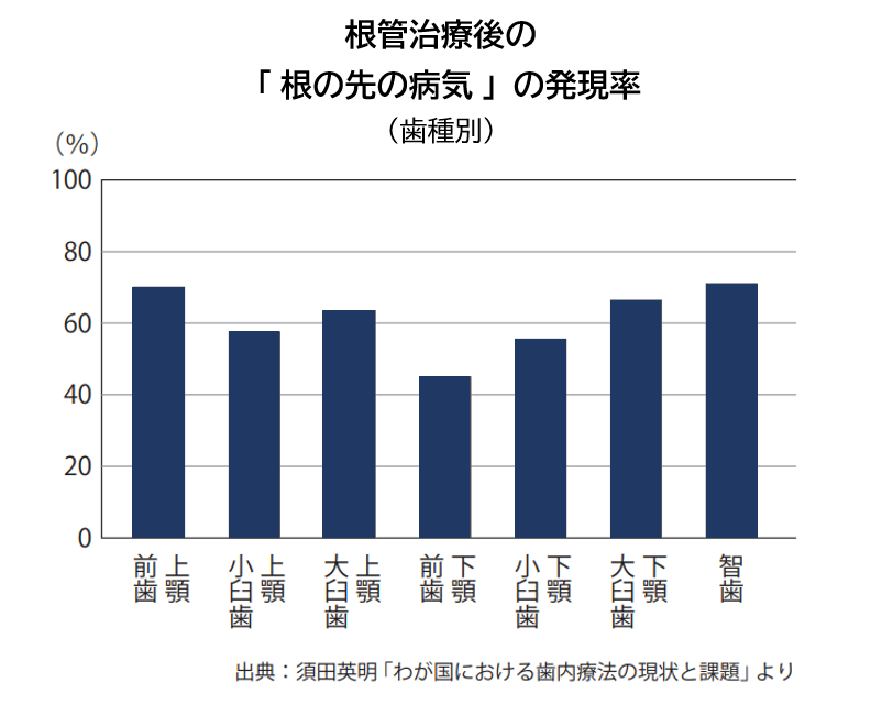 日本（保険治療）の根管治療