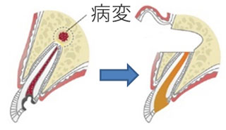 歯根端切除術