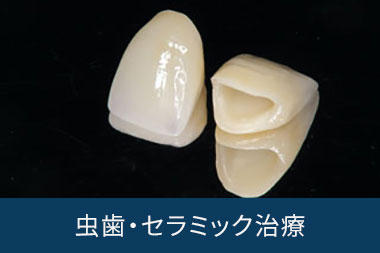 前歯のセラミックの被せ物