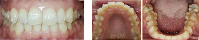 治療途中：3ヶ月目(歯の表面にアタッチメント有)