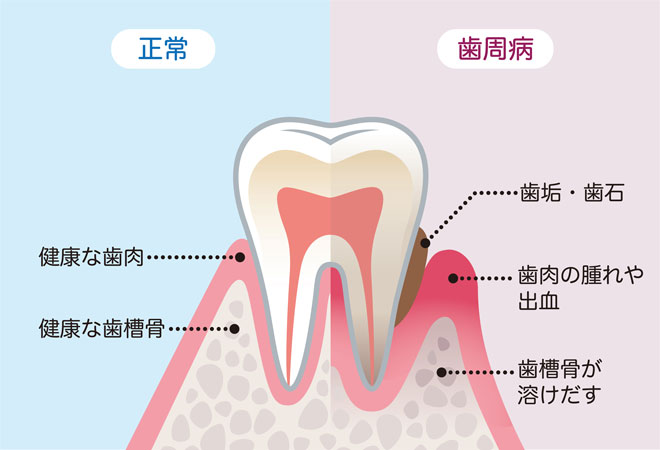 歯周病とは