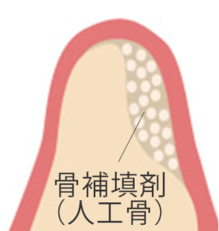 GBR　骨造成2回法