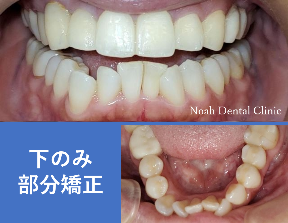 短期間 マウスピースを用いた部分矯正 治療期間4ヵ月 表参道の歯医者 ノア歯科クリニック表参道