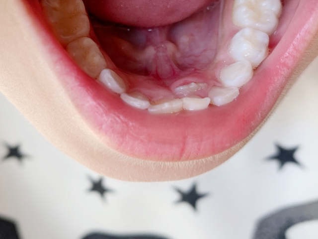 歯が黒い原因について代表的なものを紹介