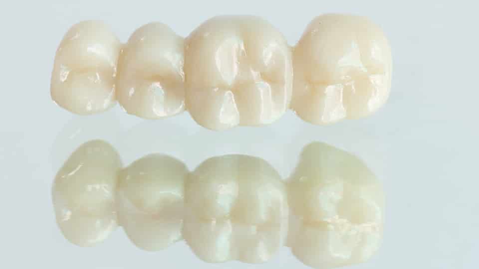 歯のセラミックにはいろんな種類がある？