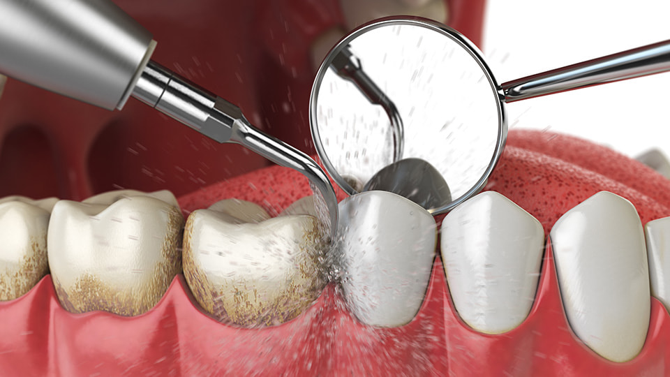 歯垢と歯石はどう違う？放っておくと健康や見た目にもダメージが