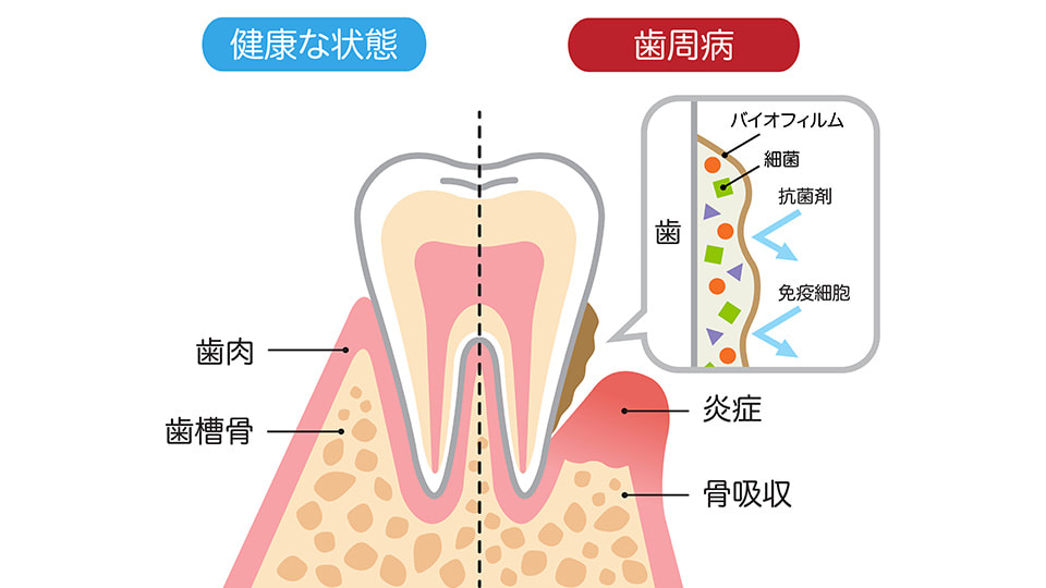 歯と健康の関係性ってどんなもの？歯周病についてもチェック
