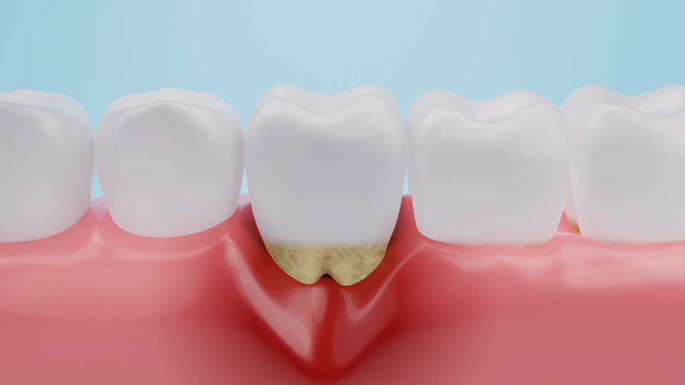 歯茎が痩せる原因と改善法