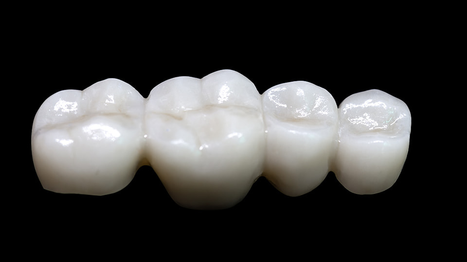 セラミックの歯とは何が違う？ジルコニアを選ぶ5つのメリット